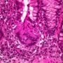 Rupture of a colonic crypt in colonic mucosal inflammation