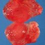 Myxoid liposarcoma