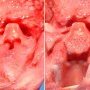 Hypopharynx and larynx