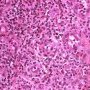 Acute inflammation with granulocytic diapedesis in ileal Crohn (...)