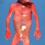 Turricephaly by intracranial neuroectodermal cyst