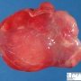 Myxoid liposarcoma
