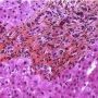 Portal fibrosis and biliary ductular proliferation in juvenile (...)