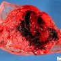 A frequent cause of fetal death: retroplacental hematoma