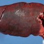Congestive spleen in spherocytosis