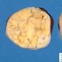 Ovarian juvenile granulosa tumor