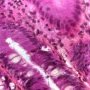 Colonic GVHD