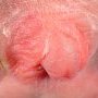 Sexual ambiguity and perineal hypospadias in mosaic monosomy X (...)