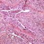Bronchiolitis obliterans after bone marrow allograft