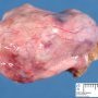 Ovarian serous cystadenoma