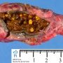 Cholelithiasis and biliary sludge