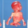 Vaginal atresia and sexual ambiguity in caudal regression syndrome with (...)
