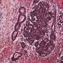 Blastemal component in Wilms tumor