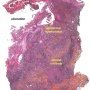 Cutaneous leishmaniasis