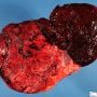 Retroplacental hematoma