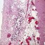 Subserosal calcification