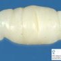 Neurofibroma