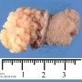 Perineal fibrolipoma. Macroscopy