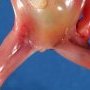 Lower limb pterygium