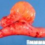 Intestinal lymphangioma