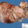 Nasal juvenile angiofibroma