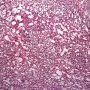 Yolk sac tumor