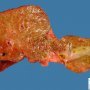 Dilatation of main bile ducts in extrahepatic biliary tract (...)