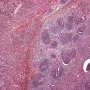 Triphasic Wilms