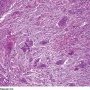 Metaphyseal fibrous defect - Microscopy (Elsevier)