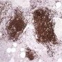 Pulmonary nodular lymphoid hyperplasia
