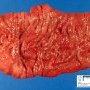 Colectomy of ulcerative colitis
