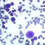 Parvovirus B19 cytopathogenic effect in bone marrow