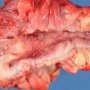 Cobblestone appearance in Crohn ileitis