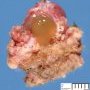 Thyroglossal tract cyst
