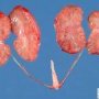 BIlateral nephromegaly in Meckel syndrome
