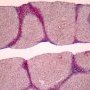 Hepatic fibrosis
