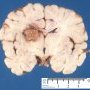 Cerebral abcess in invasive aspergillosis