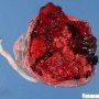 Retroplacental hematoma