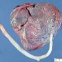 Marginal insertion of the umbilical cord