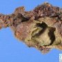 Volvulus-associated intestinal atresia
