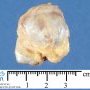 Osteochondroma