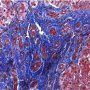 Portal fibrosis and biliary ductular proliferation in juvenile (...)
