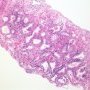 Atypical Adenomatous Hyperplasia in Needle Biopsy
