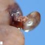 Extralobar pulmonary sequestration