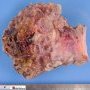 Hypodermal cystic lymphangioma