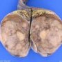 Seminoma of the testis