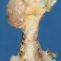 osteochondroma_06_