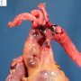 Aortic dissection in Marfan disease