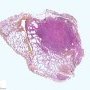 Pulmonary nodule in lymphomatoid granulomatosis