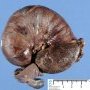 Intestinal intussuspection and infarction on Meckel diverticula